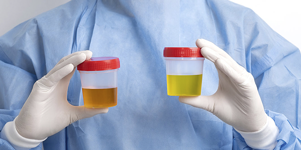 ¿Qué dice tu orina de tu salud? Guía sobre colores, olores y frecuencia