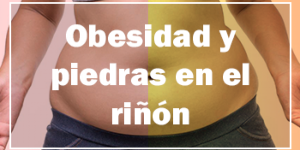 Obesidad y Piedras en el riñón