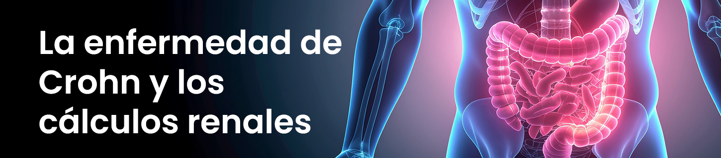 La enfermedad de Crohn y los cálculos renales