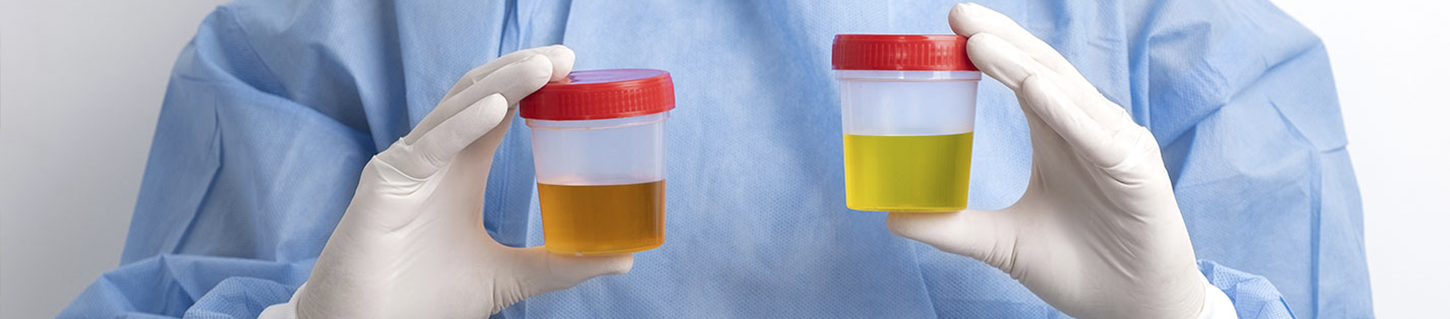 ¿Qué dice tu orina de tu salud? Guía sobre colores, olores y frecuencia